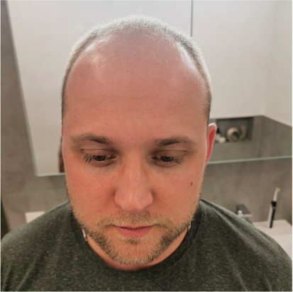 ID Haartransplantationen